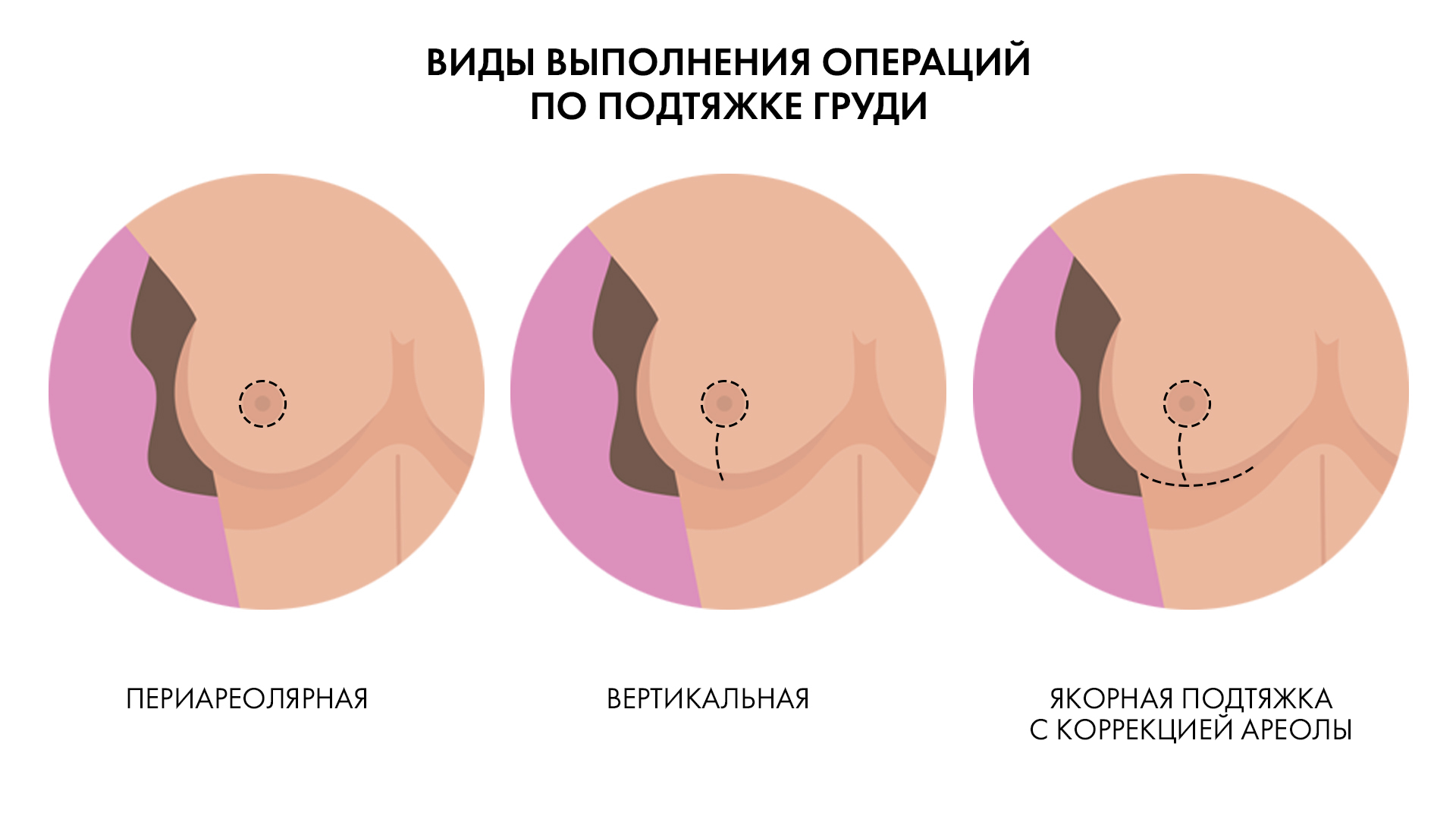 Мастопексия в Геленджике — Клиника Ланцетъ