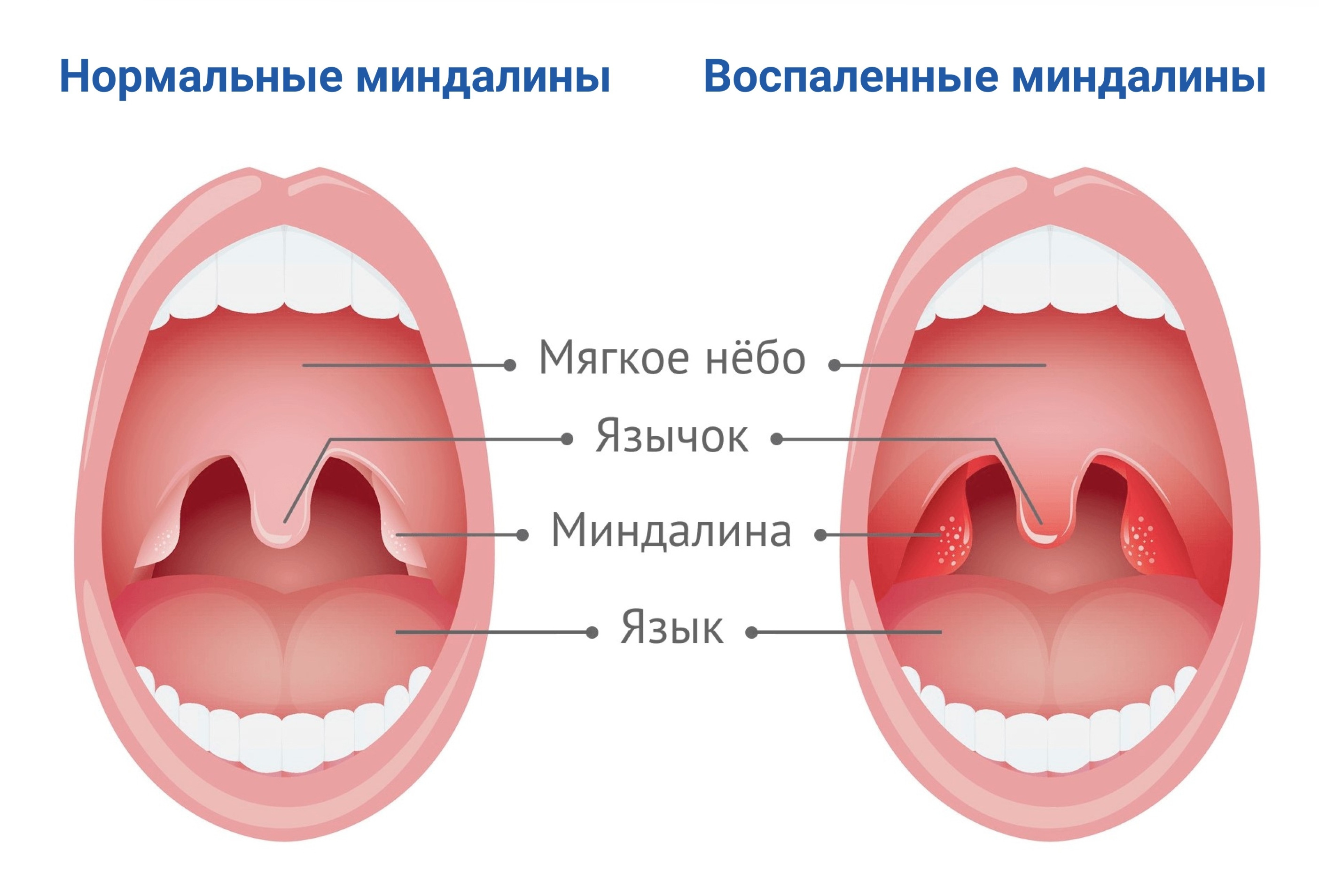 Тонзиллэктомия (удаление нёбных миндалин) — Клиника Ланцетъ