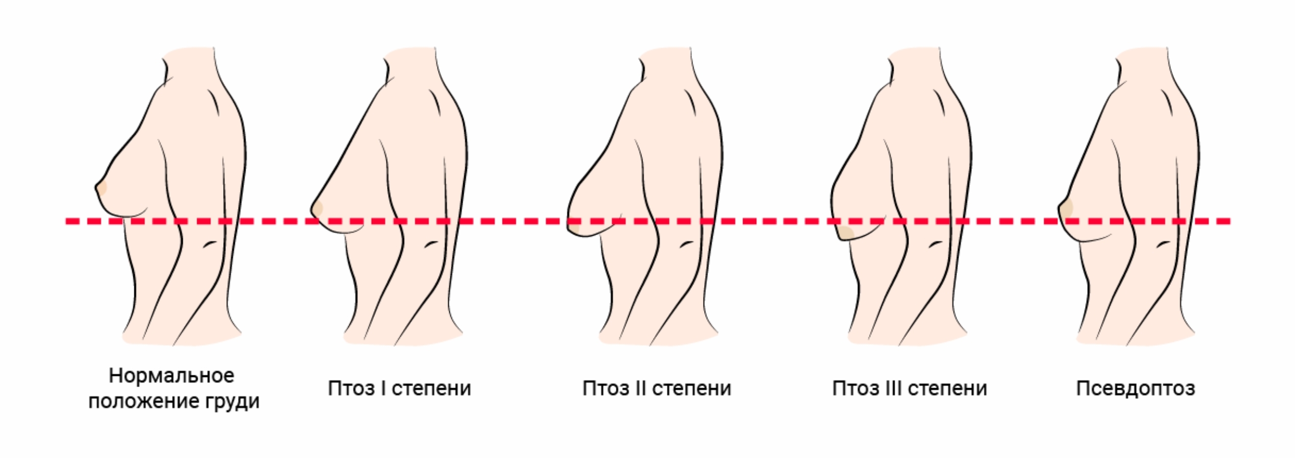 Уменьшение груди (редукция) в Геленджике — Клиника Ланцетъ