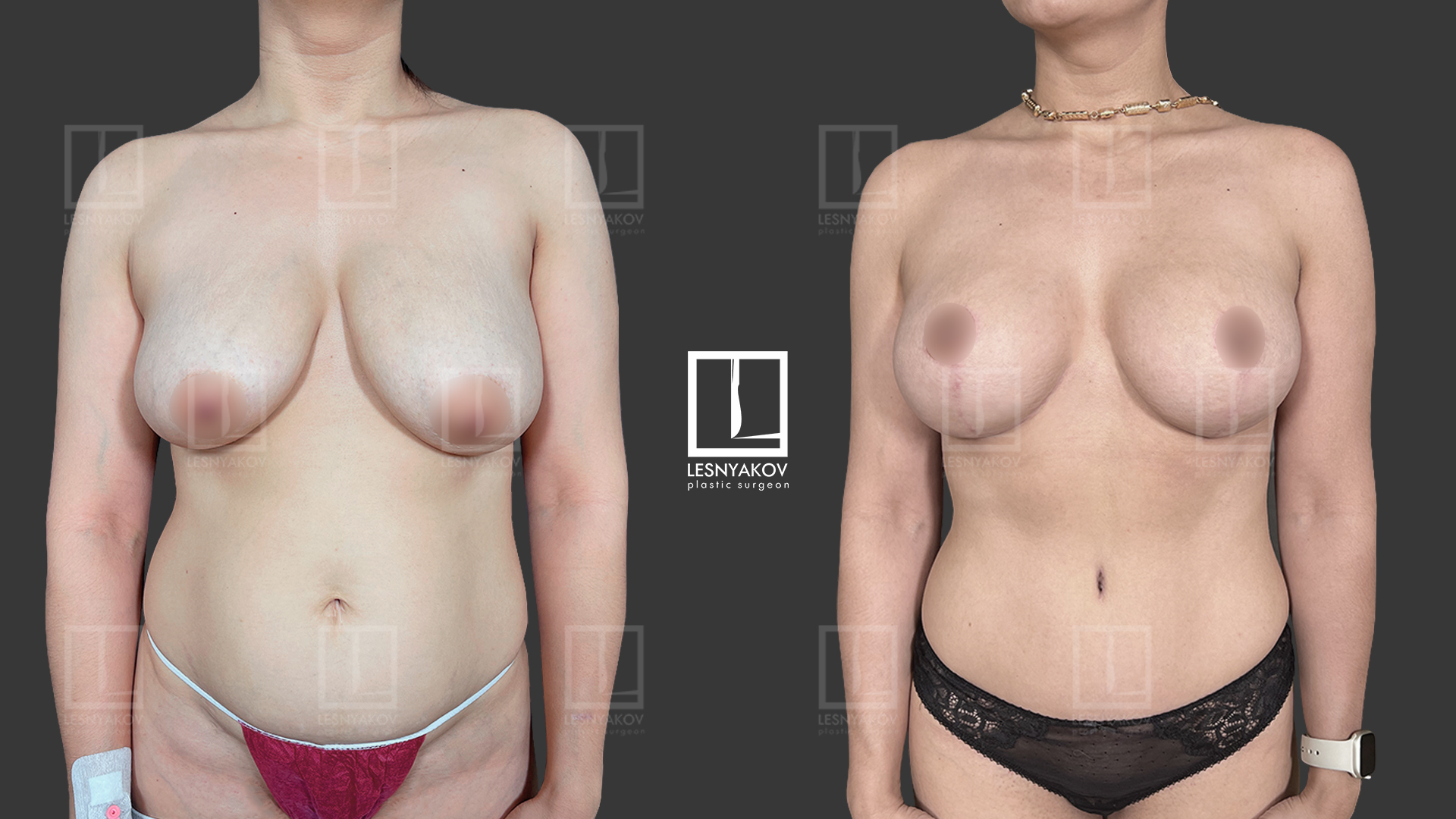 как называется операция по уменьшению груди у женщин фото 94