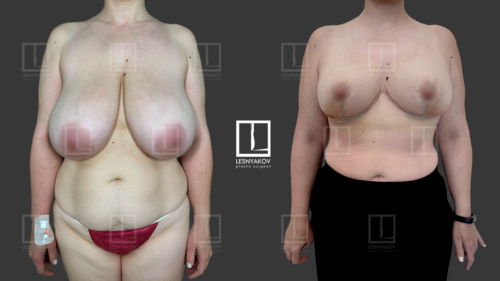 как проходит операция по уменьшению груди у женщин фото 83