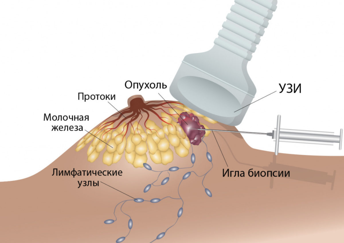 Трепан биопсия груди. Вакуумная аспирационная биопсия молочной железы. Тонкоигольная биопсия молочной железы. Тонкоигольная аспирационная пункционная биопсия. Трепан биопсия молочной железы.