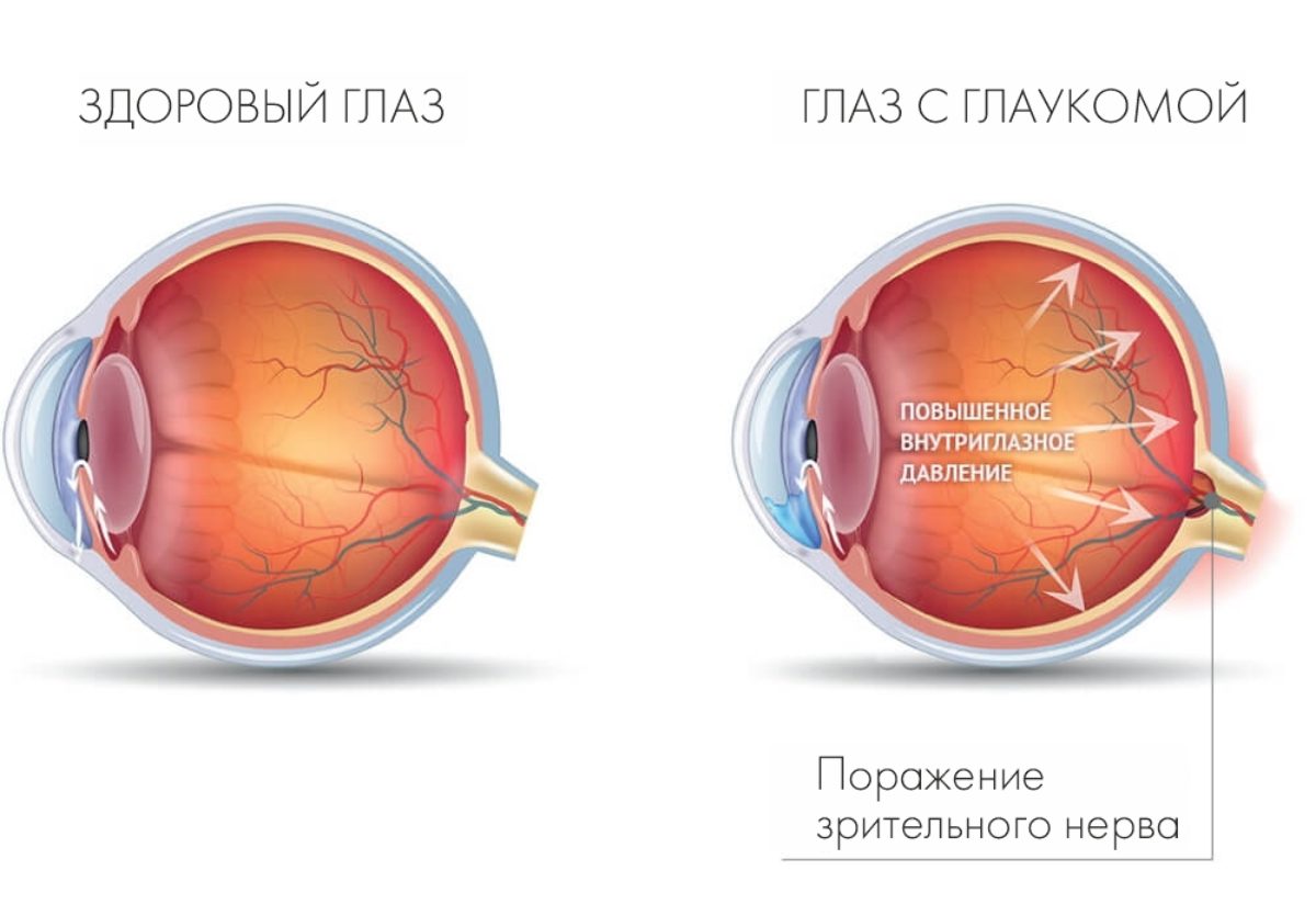 Глазное давление при глаукоме. Симптомы открытоугольной глаукомы. , Повышение внутриглазного давления, открытоугольная глаукома.