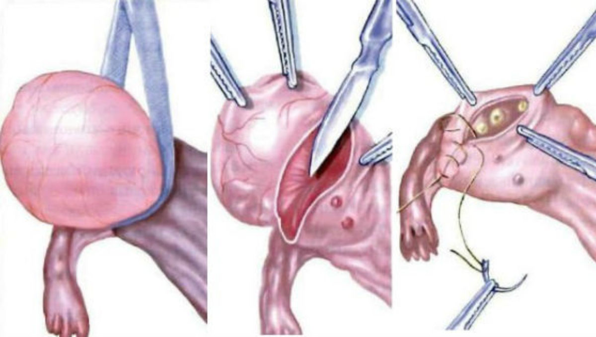 Миомэктомия - хирургическое удаление узлов миомы матки