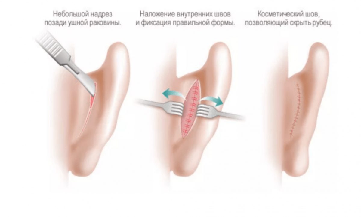 Correction of the auricle