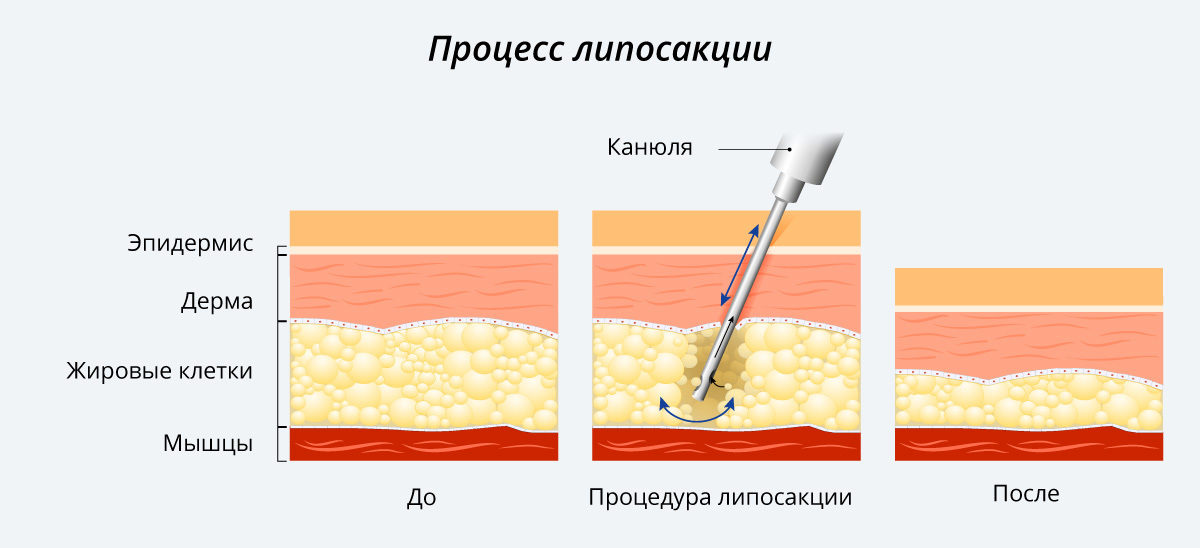 Liposuction process