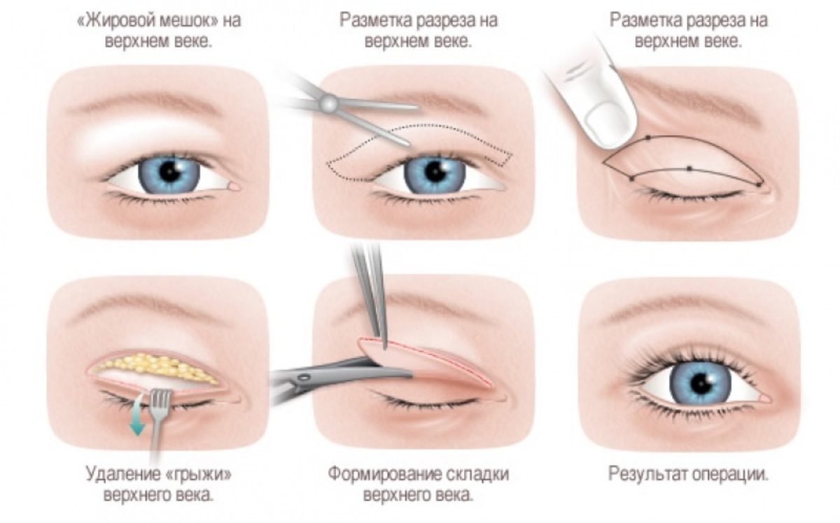 Blepharoplasty (eyelid surgery)