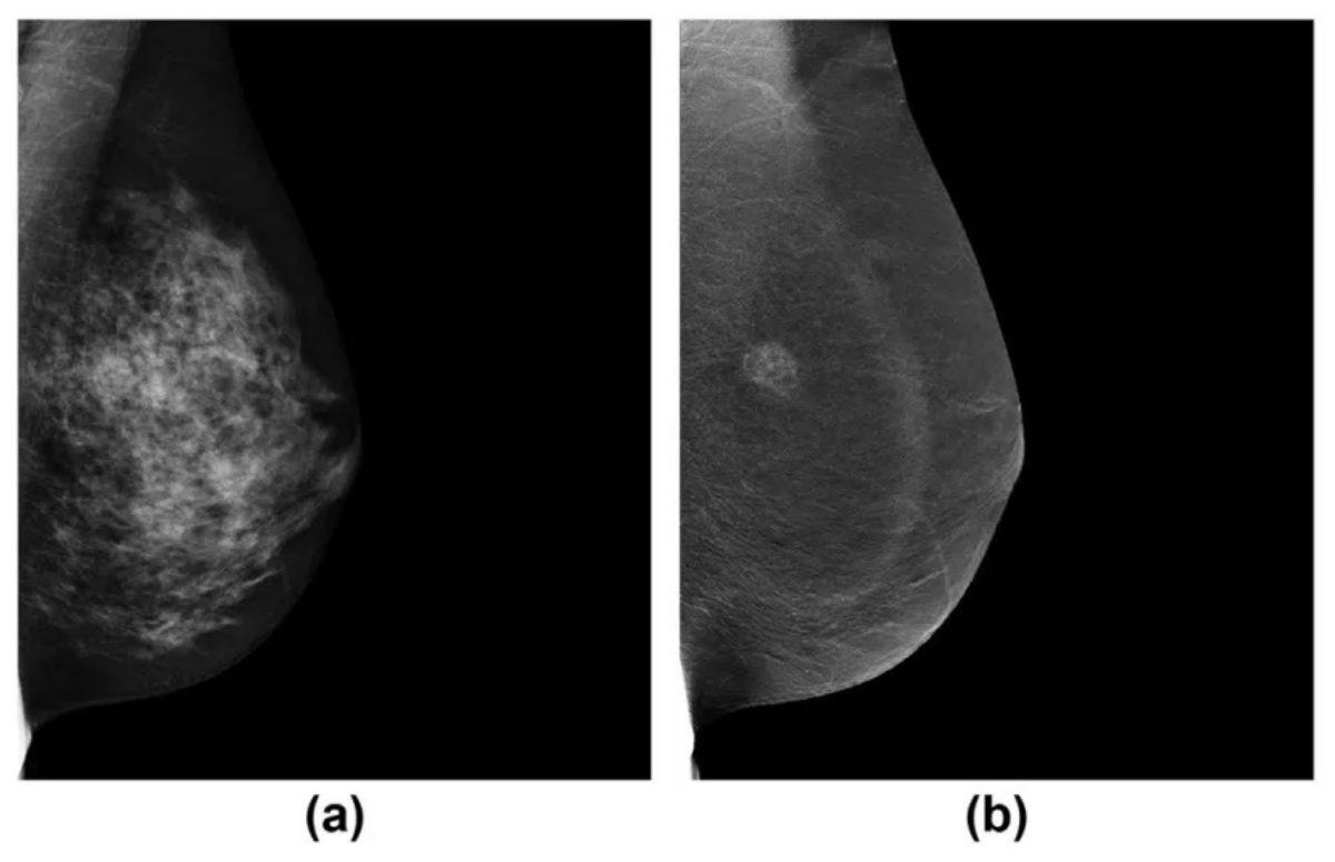 Слева — обычная маммограмма, справа — контрастная спектральная маммограмма