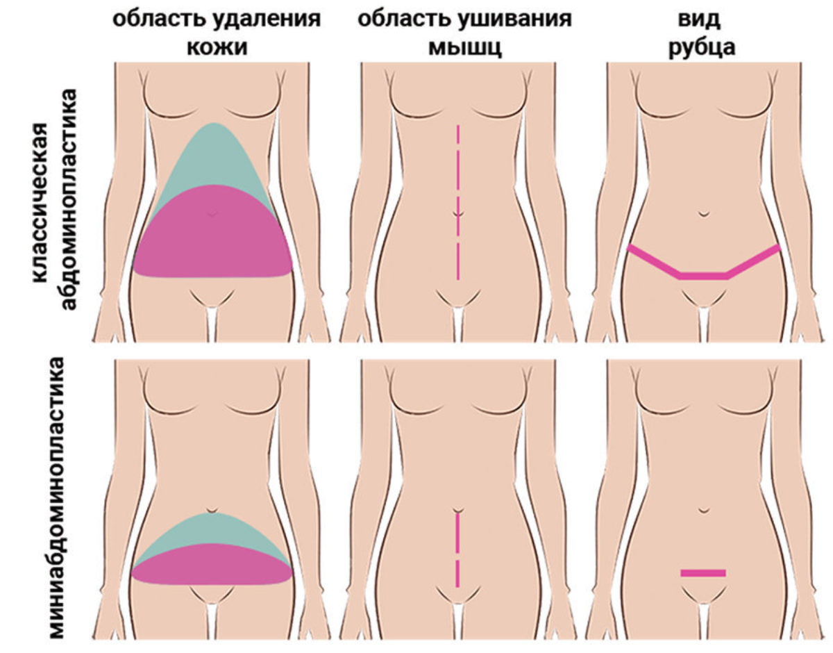 The operated area in classical abdominoplasty and mini abdominoplasty