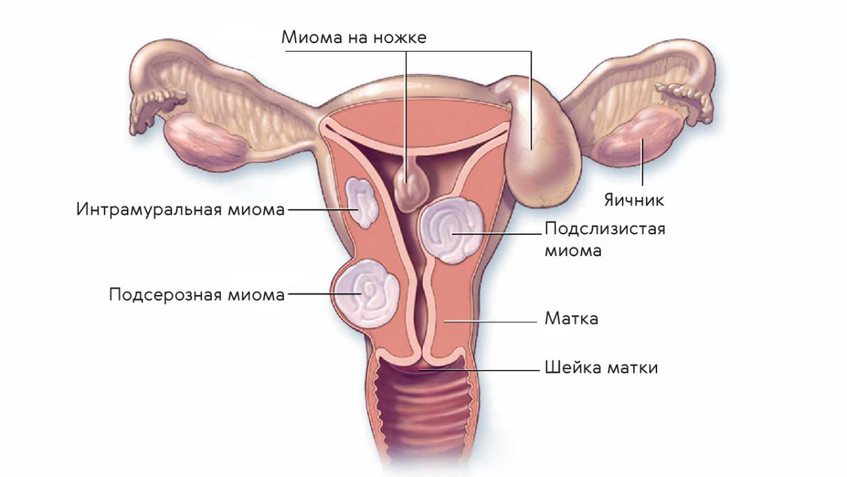 Влияние миомы матки на организм женщины