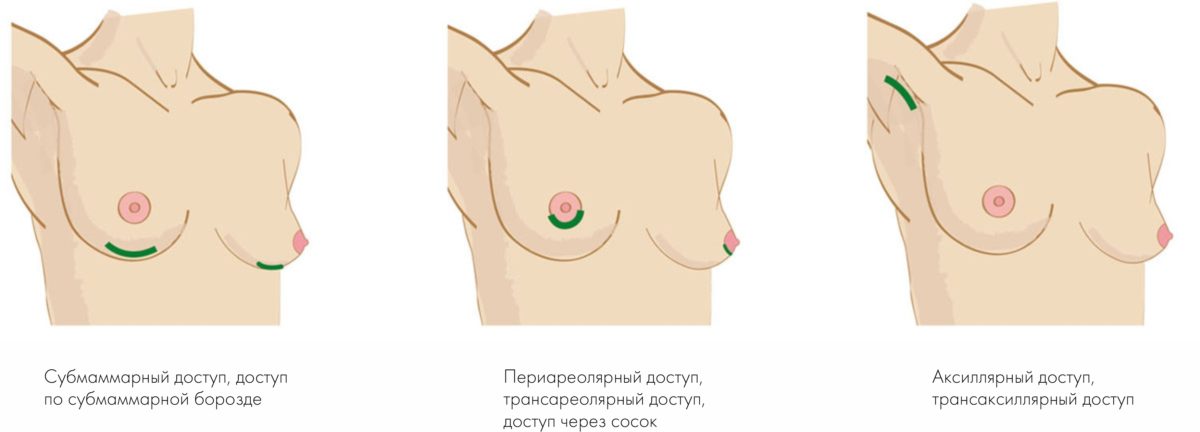 Types of accesses for the installation of breast implants