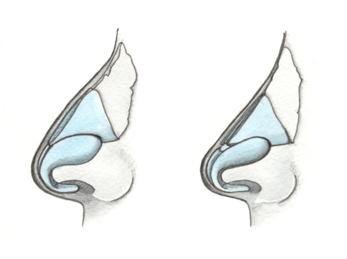 Surgical removal of the nasal hump