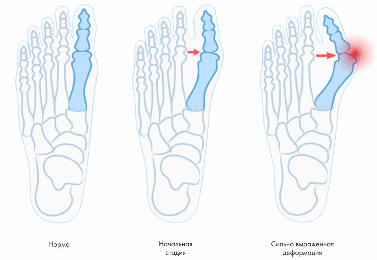 Проведение операций при вальгусной деформации стопы в клинике "Ланцетъ"