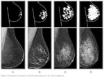 Сравнение категорий плотности груди по шкале Bi-RADS на маммографических снимках