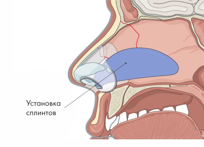 Сплинты