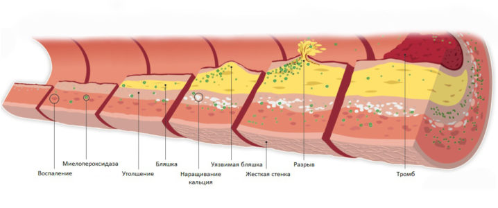 Атеросклероз сосудов