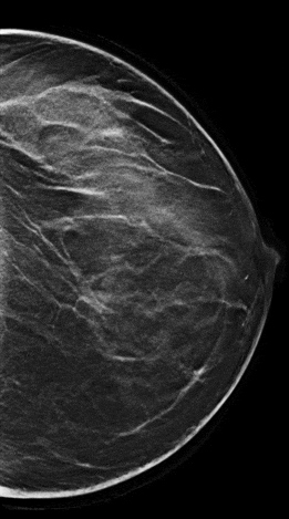 3D-снимок груди методом томосинтеза